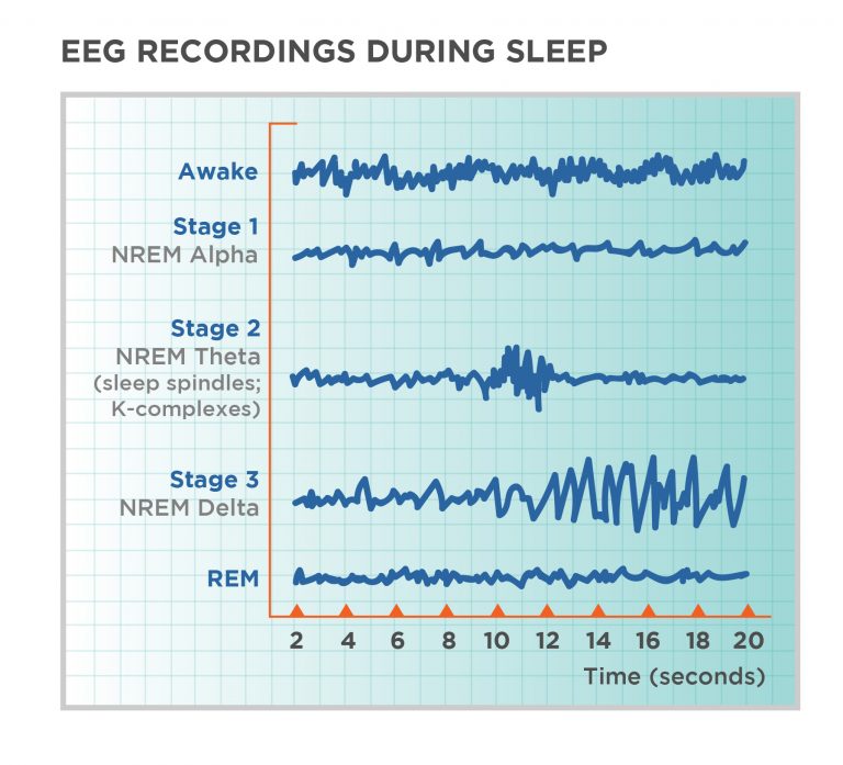 Sample EEG depicting brain waves during the different sleep cycles