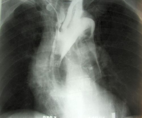 Angiogram of an aortic aneurysm