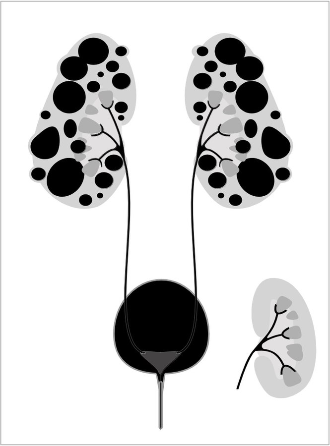 Simple black-and-white illustration of autosomal dominant polycystic kidney disease showing cysts in kidneys represented as black dots, with normal kidney for comparison on bottom right