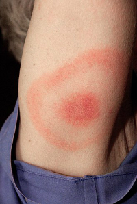 The telltale bulls-eye rash that might foretell Lyme