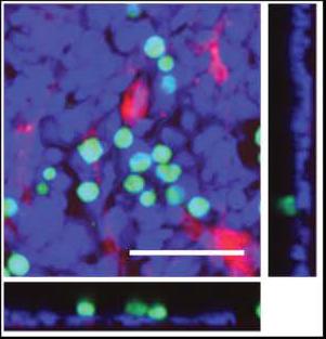 Ovarian cancer cells in a 3-D model