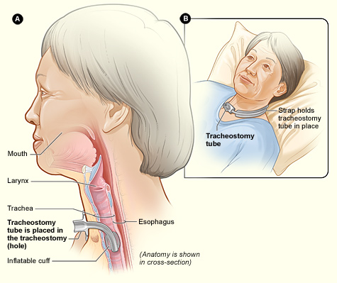 A scientific diagram showing the different parts of a tracheotomy